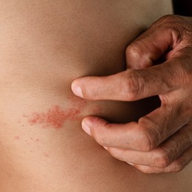 New Vaccine Schedule in Play, to Help Keep Shingles at Bay image