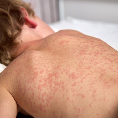 Rise of the Measles image