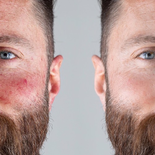 KISS: Rosacea image