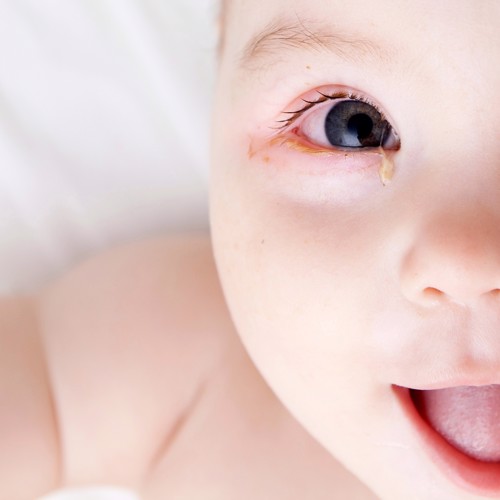 Conjunctivitis in the under 2s: Eyeing up a problem with chloramphenicol image